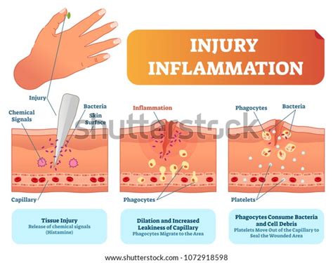 10 794 imágenes de Inflamacion tejido Imágenes fotos y vectores de