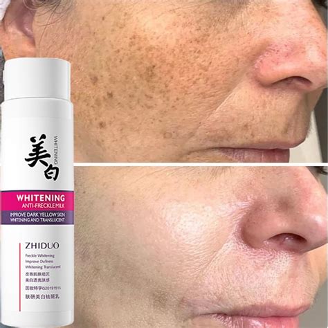 120ML Whitening Freckle Cream Nicotinamide Moisturizing Freckle Milk