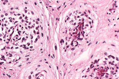 Paragangliomas | Basicmedical Key