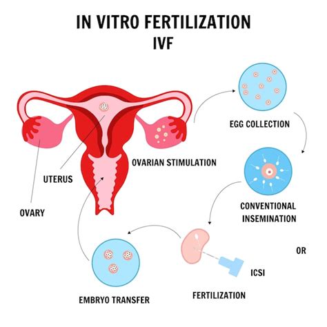 Premium Vector In Vitro Fertilization Concept With Sperm Preparation