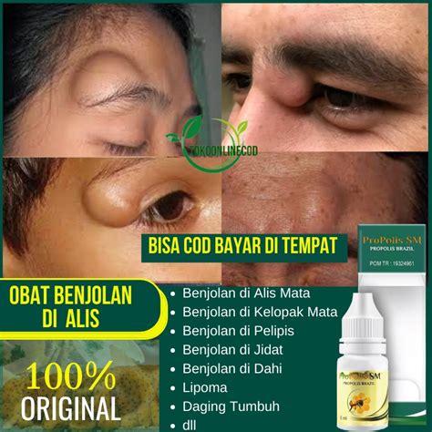 Jual Obat Benjolan Di Alis Benjolan Di Kelopak Mata Penumpas Benjolan