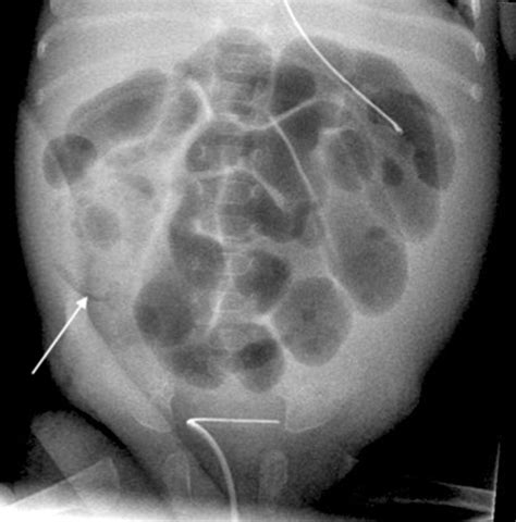 How To Use Abdominal X Rays In Preterm Infants Suspected Of Developing Necrotising Enterocolitis