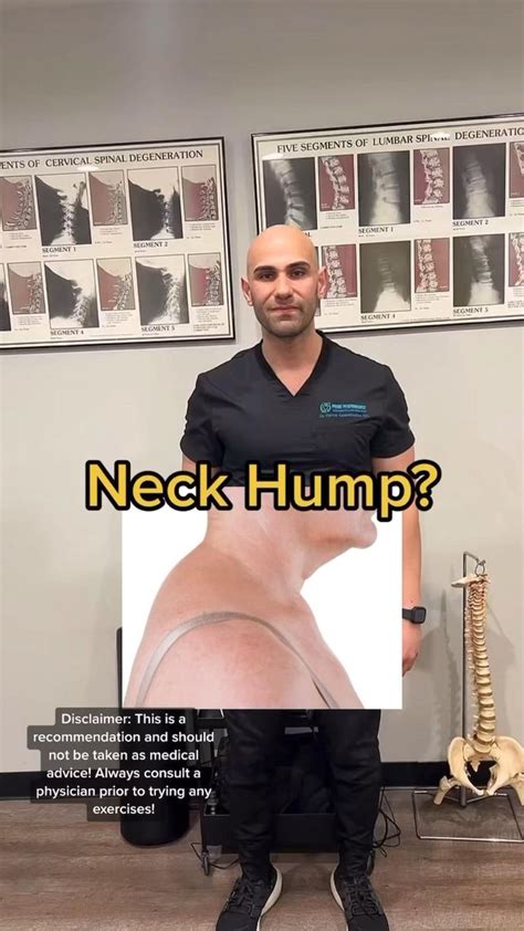 Neck Hump Try Share Neck Hump Posture Exercises Forward Head