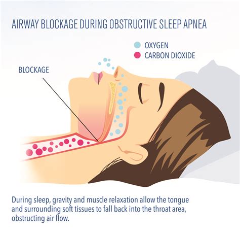 What Is Sleep Apnea New Jersey Sleep Apnea Solutions