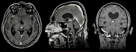 Preoperative Mri T1 Weighted Contrast Enhancement Illustrating Lesion