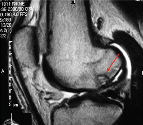 primary repair  osteochondritis dissecans   knee clinical tree