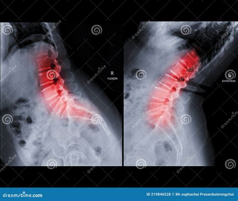 Imagen En Rayos X De La Flexi N Lateral De La Columna Lumbar Y Vista De