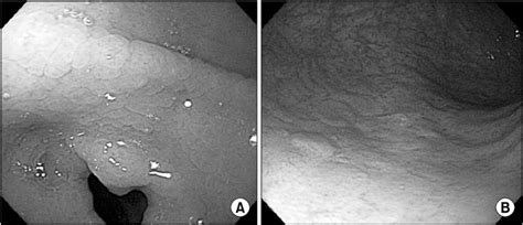 Upper Gastrointestinal Endoscopic Examination Showing Diffuse Mucosal