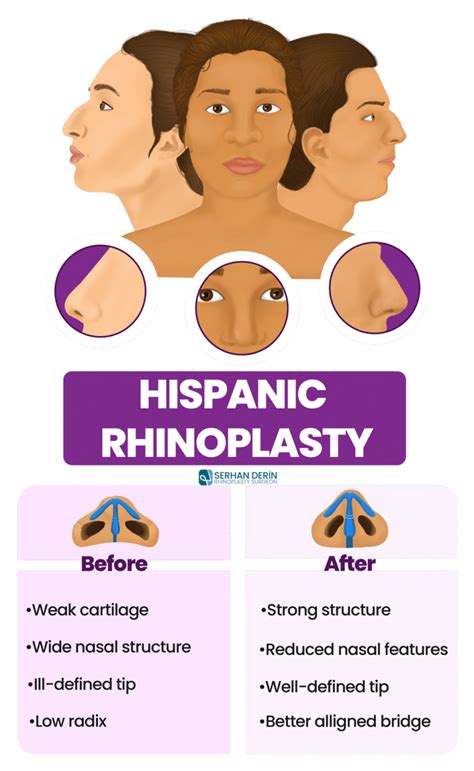 Hispanic Rhinoplasty Details Approaches Pros And Cons