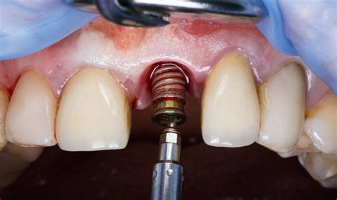 Step By Step Process For Successful Dental Implants