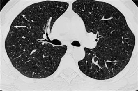 Bronchiolitis Ct Scan