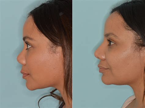 Rhinoplasty Photos Miami Fl Patient 3235