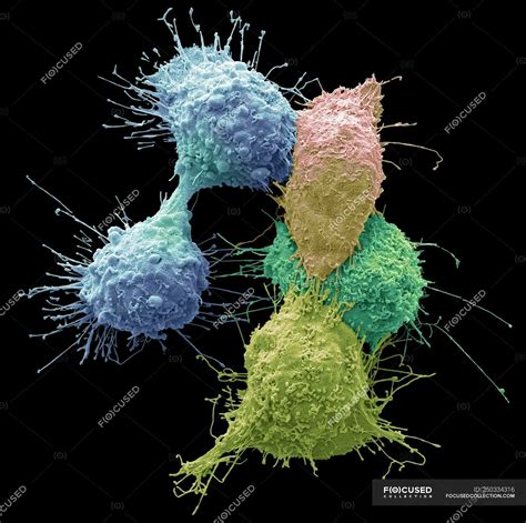 Coloured scanning electron micrograph of ovarian cancer cells ...