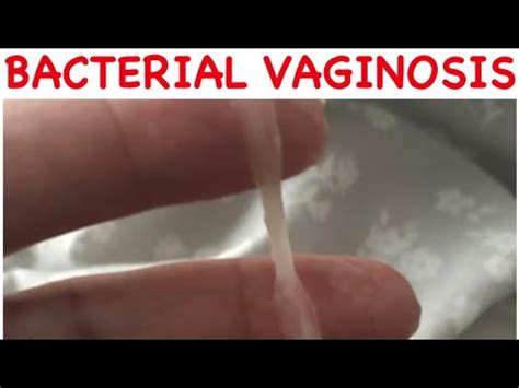 HOW TO KNOW IF YOU HAVE BACTERIAL VAGINOSIS BV MED IN A MINUTE D N