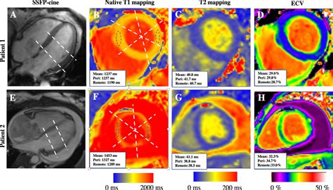 Multiparametric Mapping By Cardiovascular Magnetic Resonance Imaging In