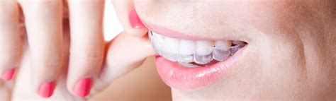 Invisalign Aligner Therapy In Joplin Mo Adc Dental Group