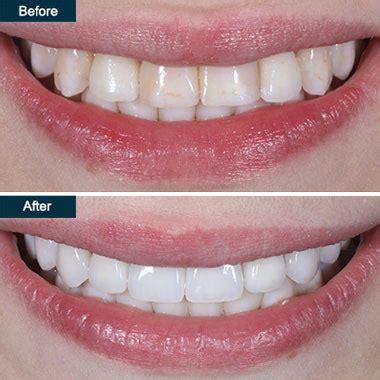 professional teeth whitening near me best Teeth whitening caloundra