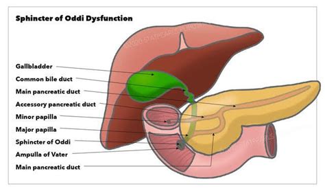 Sphincter Of Oddi Dysfunction Surgical Focus