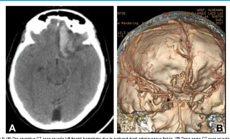 Figure From Curative Embolization Of Dural Arteriovenous Fistula