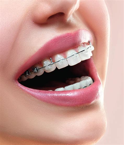 Ceramic Braces In Dubai Clear Fixed Ceramic Braces In Dubai