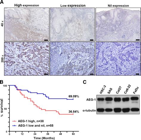 Aeg 1 Expression In Clinical Specimens Of Oscc And Cell Lines Of Hnscc