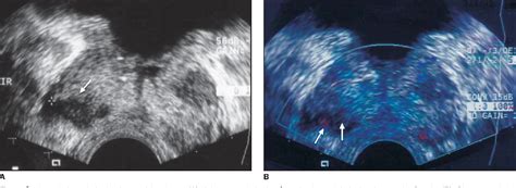 Figure From Current Role Of Transrectal Ultrasonography In The Early