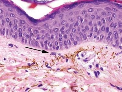 Ochronosis Histology