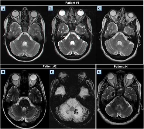 Cerebellar Peduncle Mri