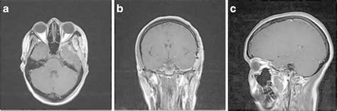 Postoperative Mri Showing The Complete Removal Of The Lesion Download