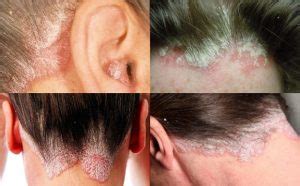 Psoriasis Diferentes Tipos De Psoriasis Salud Doncomos