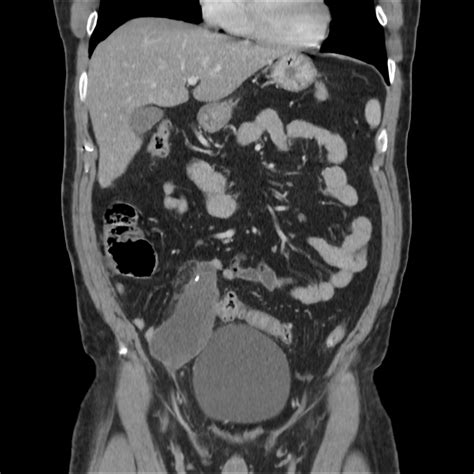 Mucocele Of The Appendix Image