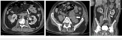 Ct Scan Of The Abdomen And Pelvis Ct Abdomen And Pelvis Ctap In