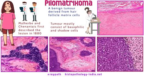 Pathology Of Pilomatrixoma Dr Sampurna Roy MD Histopathology India Net