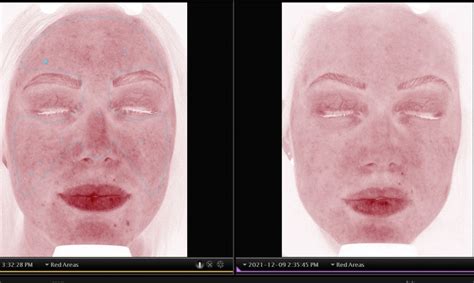 Visia® Skin Analysis Winnipeg Victoria Park Medispa The Derm Centre