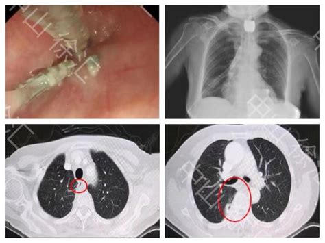 中山内镜堵瘘篇之二 食管癌术后吻合口瘘 微医（挂号网）