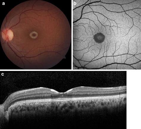 Fundus Photograph A B Faf B And Sd Oct C Images Of Patient