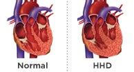 Hypertensive Heart Disease: Types, Symptoms, and Diagnosis