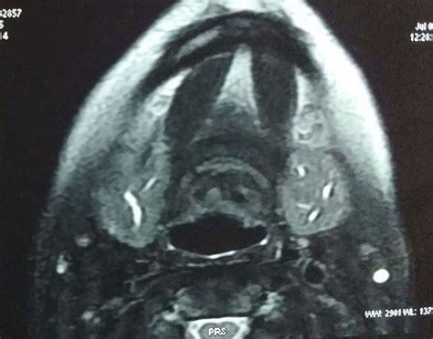 Giant Mediastinal Parathyroid Adenoma Presenting As Bilateral Brown Tumour Of Mandible A Rare