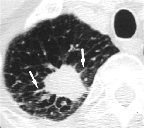 Ct Findings Of Surgically Resected Large Cell Neuroendocrine Carcinoma Of The Lung In 38