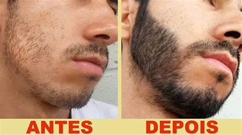 Minoxidil O Que É e Como Usar Para Fazer Sua Barba Crescer Moda Para