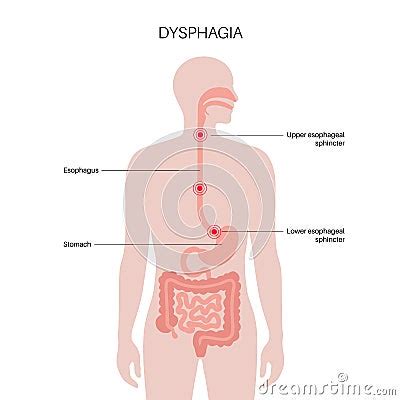 Dysphagia Medical Poster Vector Illustration Cartoondealer