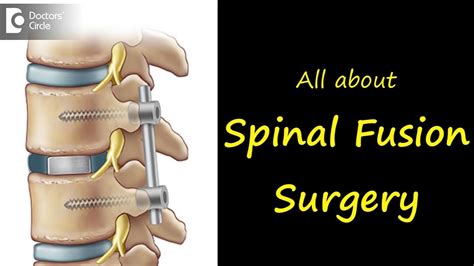 How Is A Spinal Fusion Surgery Performed Dr Kodlady Surendra Shetty