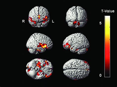 Patterns Of Gray Matter Atrophy According To Bpsd Progression Atrophic