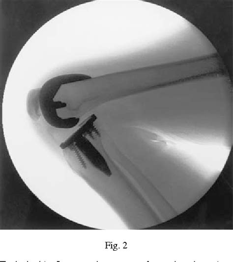 Figure 1 From Fluoroscopic Analysis Of The Kinematics Of Deep Flexion