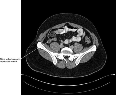 Appendiceal Mucocele A Missed Diagnosis Bmj Case Reports