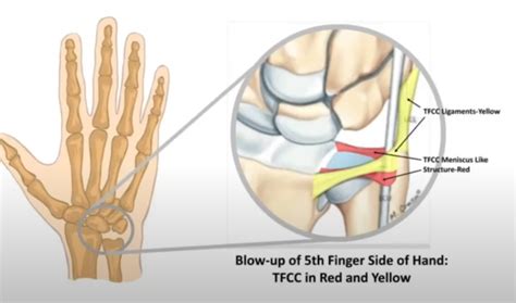 TFCC injury of wrist dysfunction – Aopuqi