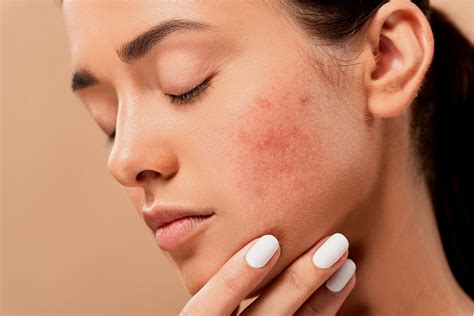 How Dermatologists Control Cystic Acne Beauty World News