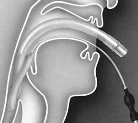 The Laryngeal Mask Airway Potential Applications In Neonates Adc