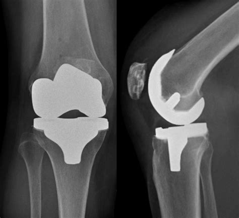 total knee replacement castleview clinic