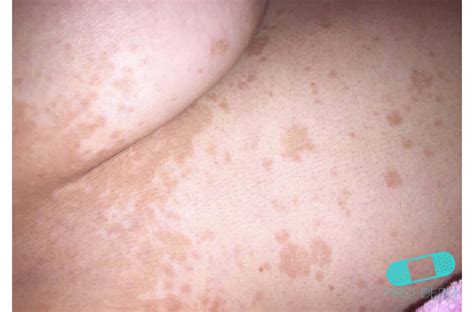 Pityriasis Versicolor Tinea Verisicolor Online Dermatologist